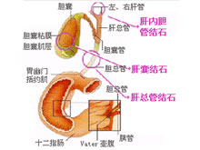 肝内胆管结石