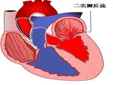 先天性二尖瓣关闭不全