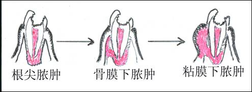 根尖脓肿