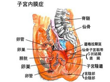 慢性子宫内膜炎