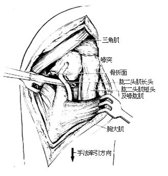 肱骨外科颈骨折