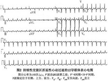 持续性交接区折返性心动过速