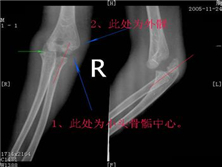 肱骨远端全骨骺分离