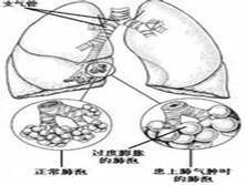 抗胰蛋白酶缺乏症