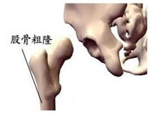 股骨粗隆间骨折