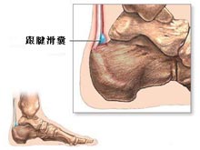 跟腱后滑囊炎