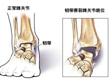 踝关节脱位