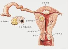 外阴纤维肉瘤