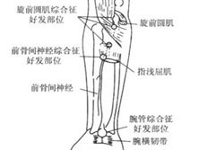 前骨间神经卡压综合征