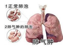 老年肺气肿