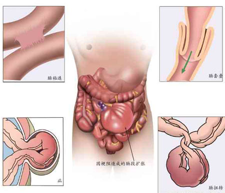 小儿粘连性肠梗阻