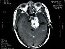 枕骨大孔脑膜瘤