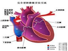 完全性肺静脉异位引流