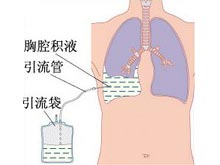 类肺炎性胸腔积液