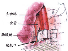 食管撕伤和破裂