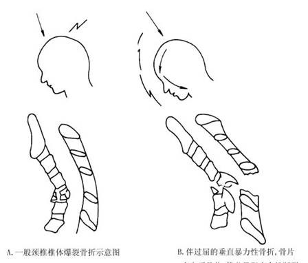 椎体爆裂骨折