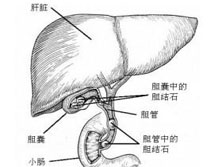 妊娠合并急性胆囊炎