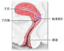 子宫颈残端癌