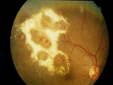 外层渗出性视网膜病变