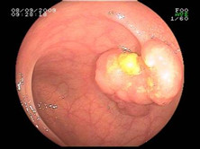 老年结肠息肉