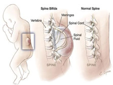 先天性脊柱裂