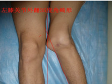 先天性膝关节畸形