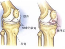 褐黄病性关节炎