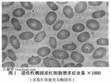 小儿遗传性椭圆形红细胞增多症