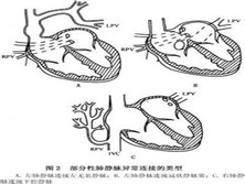 小儿部分性肺静脉异位连接