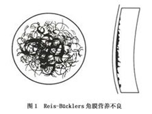 Reis-Bucklers角膜营养不良