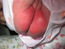 新生儿尿布皮炎