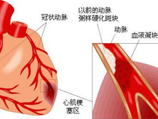 小儿预激综合征