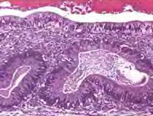 卵巢混合性生殖细胞-性索间质肿瘤