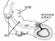 憩室病