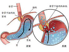 食管源性胸痛